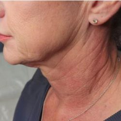 Sofwave Before & After Patient #1601